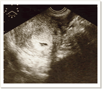 妊娠2ヶ月、超音波検査で初お目見え！