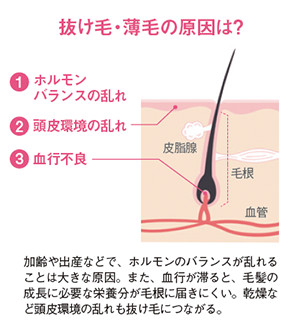 抜け毛・薄毛の原因は？ 1.ホルモンバランスの乱れ 2.頭皮環境の乱れ 3.血行不良