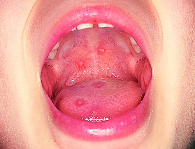 中 水疱 の 口 口の中を噛んだら速攻処置、口内炎は予防が大切