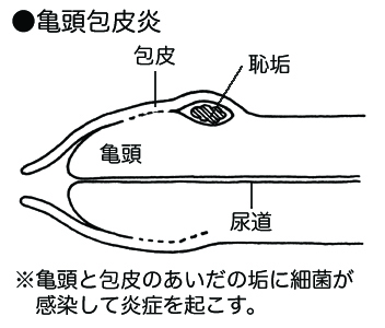 亀頭包皮炎 子ども医学館 妊娠 出産 育児に関する総合情報サイト ベビカム