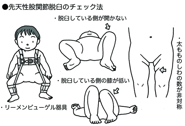 発育性股関節形成不全 子ども医学館 妊娠 出産 育児に関する総合情報サイト ベビカム