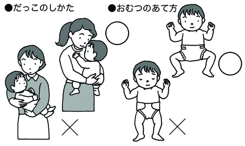 発育性股関節形成不全 子ども医学館 妊娠 出産 育児に関する総合情報サイト ベビカム