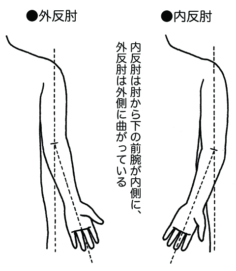 骨折の後遺症にみられる外反肘 内反肘 子ども医学館 妊娠 出産 育児に関する総合情報サイト ベビカム