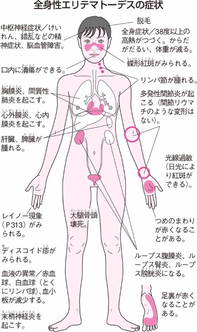 全身性エリテマトーデス Sle ウィメンズ メディカ 妊娠 出産 育児に関する総合情報サイト ベビカム