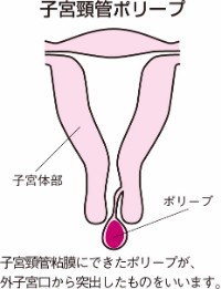 子宮 頚 管 ポリープ 切除 痛かっ た