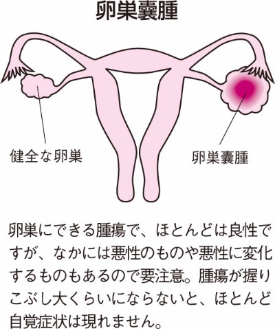 良性 卵巣 腫瘍