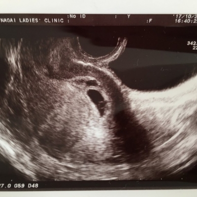 胎嚢のエコー写真について 妊娠初期 1ヶ月 2ヶ月 3ヶ月 4ヶ月 ベビカム相談室 ベビカム