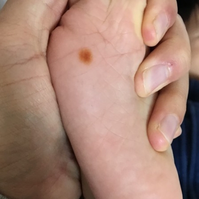 柑皮症 子育て期 生後10ヶ月 11ヶ月 12ヶ月 1歳1ヶ月 1歳2ヶ月 1歳3ヶ月 1歳4ヶ月 1歳5ヶ月 1歳6ヶ月 ベビカム相談室 ベビカム