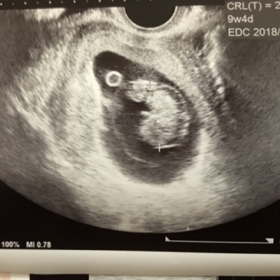胎児の浮腫について 妊娠初期 1ヶ月 2ヶ月 3ヶ月 4ヶ月 ベビカム相談室 ベビカム
