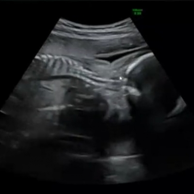 23週 Nt 胎児頚部浮腫 について 妊娠後期 5ヶ月 6ヶ月 7ヶ月 8ヶ月 9ヶ月 ベビカム相談室 ベビカム