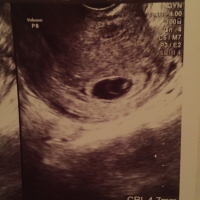 妊娠8週だが胎芽4 7mmと小さい 妊娠初期 1ヶ月 2ヶ月 3ヶ月 4ヶ月 ベビカム相談室 ベビカム