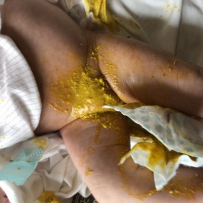 生後1ヶ月の赤ちゃんの便について 子育て期 生後0ヶ月 1ヶ月 2ヶ月 3ヶ月 4ヶ月 ベビカム相談室 ベビカム 生後1ヶ月の赤ちゃんの便について 子育て期 生後0ヶ月 1ヶ月 2ヶ月 3ヶ月 4ヶ月 ベビカム相談室 ベビカム