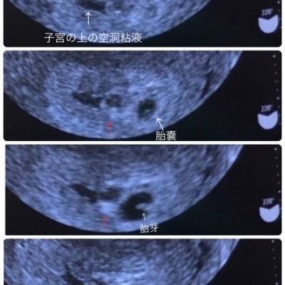 双子かどうかについての質問です 妊娠初期 1ヶ月 2ヶ月 3ヶ月 4ヶ月 ベビカム相談室 ベビカム