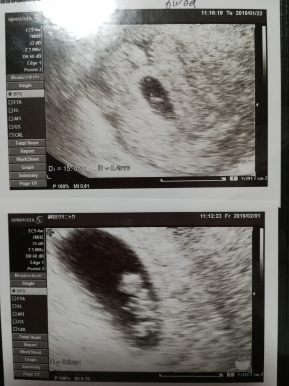 胎嚢確認 ID:10129 妊娠2ヶ月（6週0日）の写真