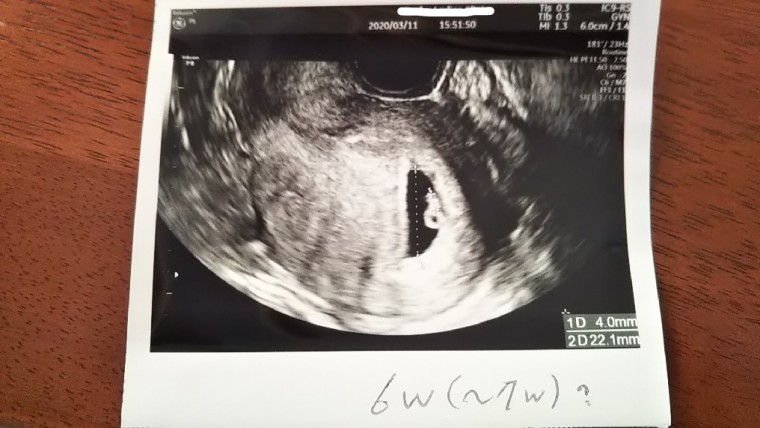 胎嚢確認 ID:10607 妊娠2ヶ月（7週0日）の写真