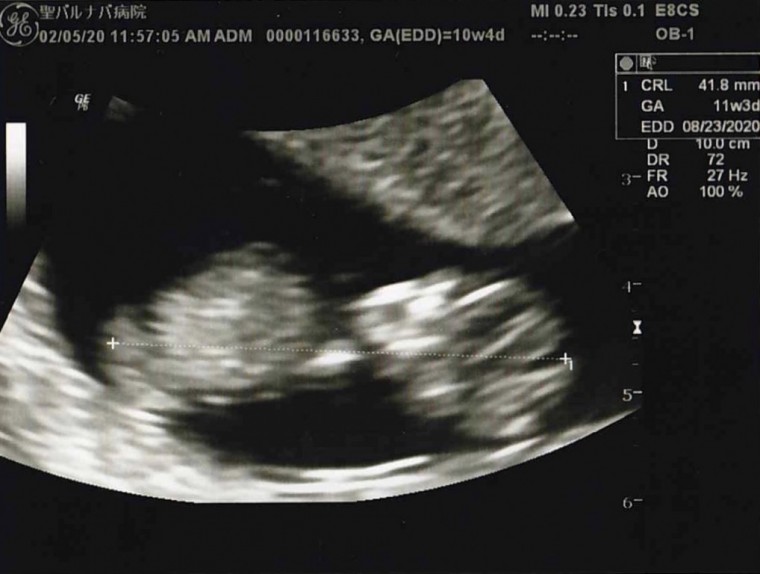 4回目の健診 ID:10587 妊娠3ヶ月（10週4日）の写真