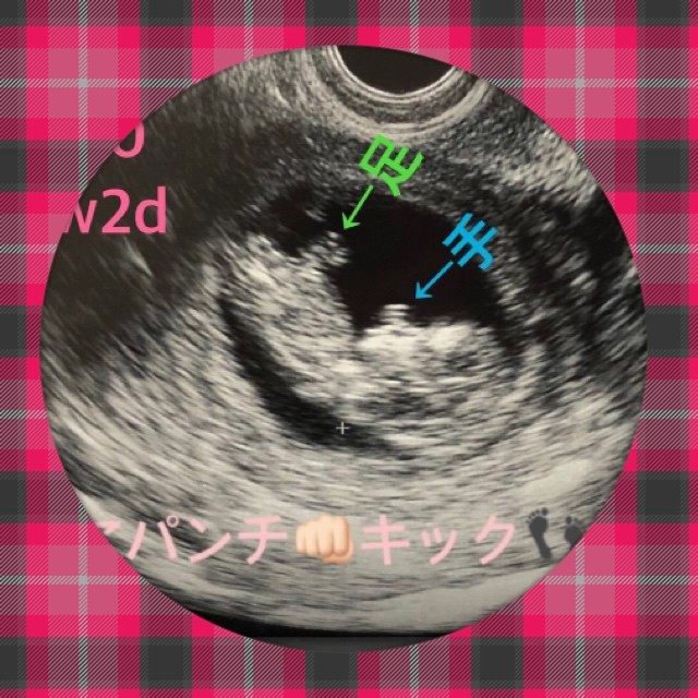 妊娠3ヶ月 妊娠8週 9週 10週 11週 妊娠初期 の超音波写真 妊娠 出産 育児に関する総合情報サイト ベビカム