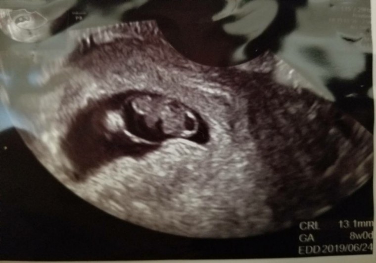 心拍確認！ ID:7012 妊娠3ヶ月（8週0日）の写真