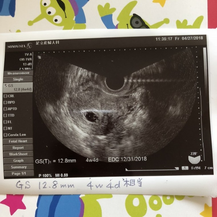 妊娠2ヶ月 妊娠4週 5週 6週 7週 妊娠初期 の超音波写真 妊娠 出産 育児に関する総合情報サイト ベビカム