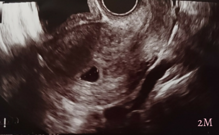  ID:423 妊娠2ヶ月（6週0日）の写真