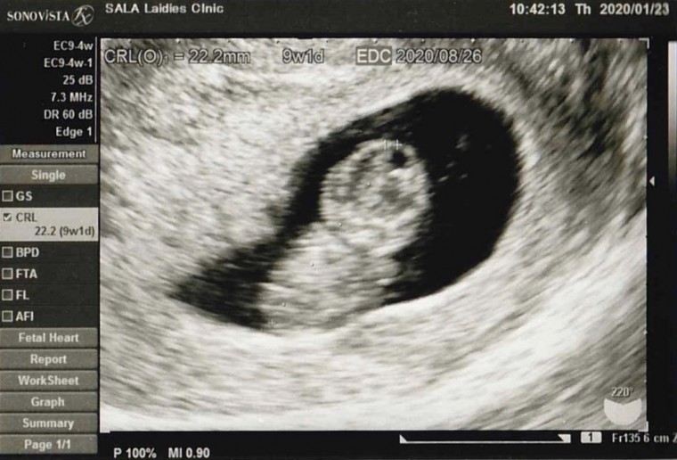 3回目の健診 ID:10586 妊娠3ヶ月（8週5日）の写真