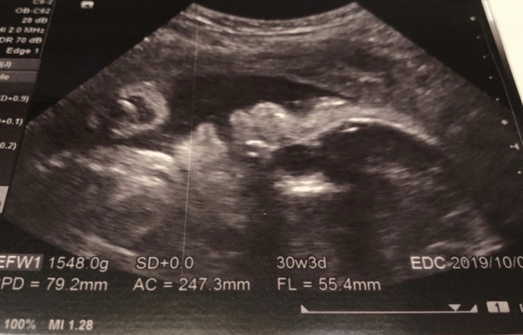 妊娠8ヶ月 妊娠28週 29週 30週 31週 妊娠後期 の超音波写真 妊娠 出産 育児に関する総合情報サイト ベビカム