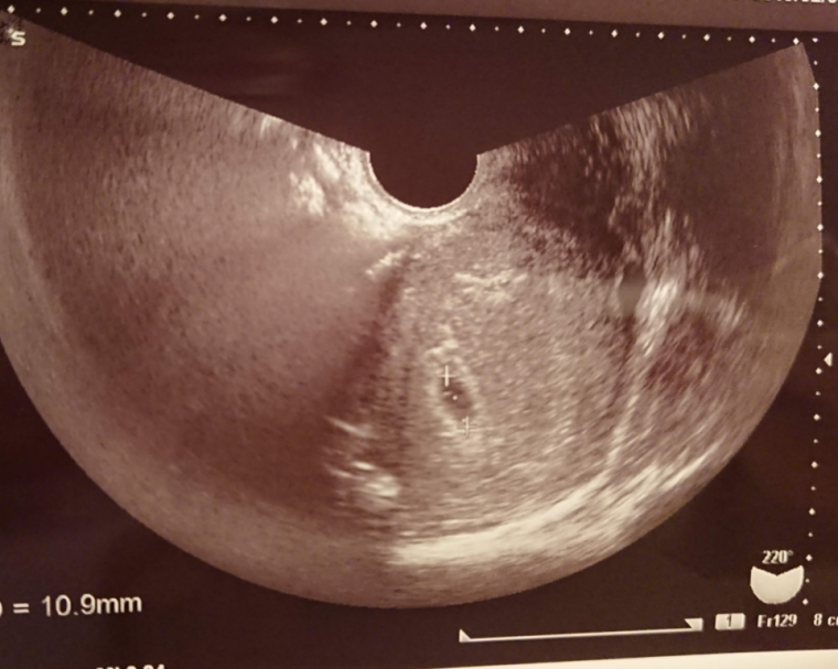 妊娠2ヶ月 妊娠4週 5週 6週 7週 妊娠初期 の超音波写真 妊娠 出産 育児に関する総合情報サイト ベビカム