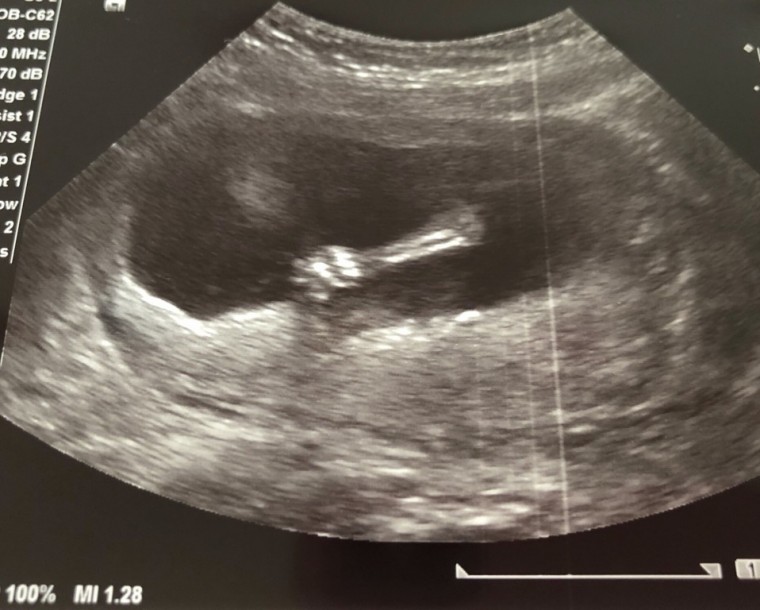 妊娠4ヶ月 妊娠12週 13週 14週 15週 妊娠初期 の超音波写真 妊娠 出産 育児に関する総合情報サイト ベビカム
