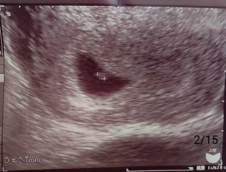 まだ心拍確認できず ID:9090 妊娠2ヶ月（6週3日）の写真