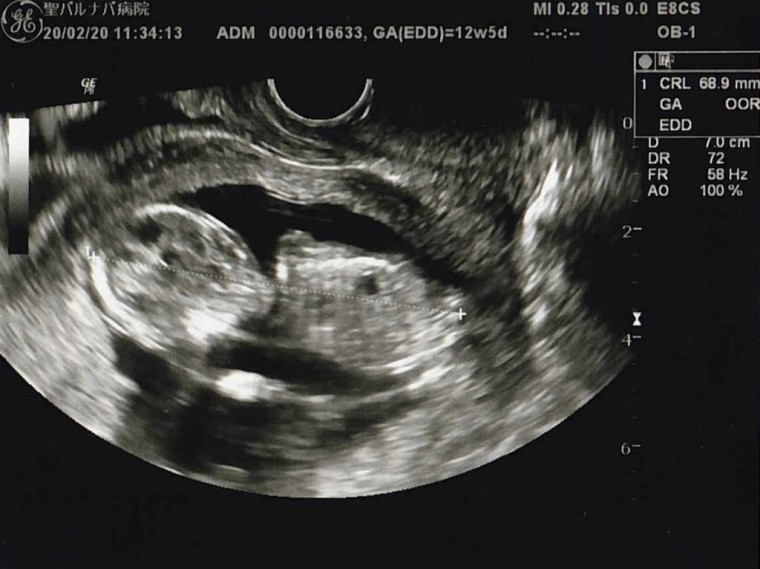 5回目の健診 ID:10588 妊娠4ヶ月（12週5日）の写真