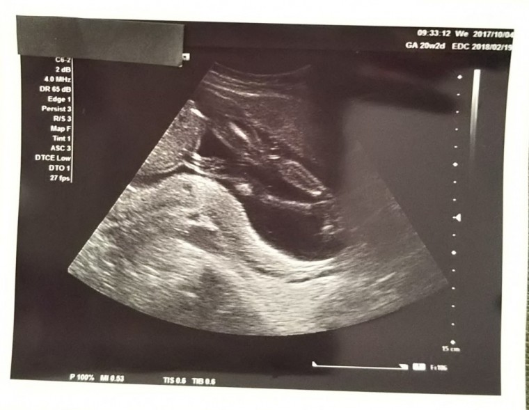 妊娠6ヶ月 妊娠週 21週 22週 23週 妊娠中期 の超音波写真 妊娠 出産 育児に関する総合情報サイト ベビカム