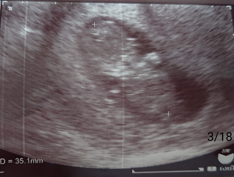 妊娠3ヶ月 妊娠8週 9週 10週 11週 妊娠初期 の超音波写真 妊娠 出産 育児に関する総合情報サイト ベビカム