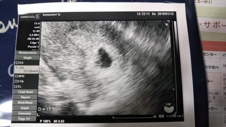 妊娠が分かって、はじめての受診 ID:10125 妊娠2ヶ月（5週0日）の写真
