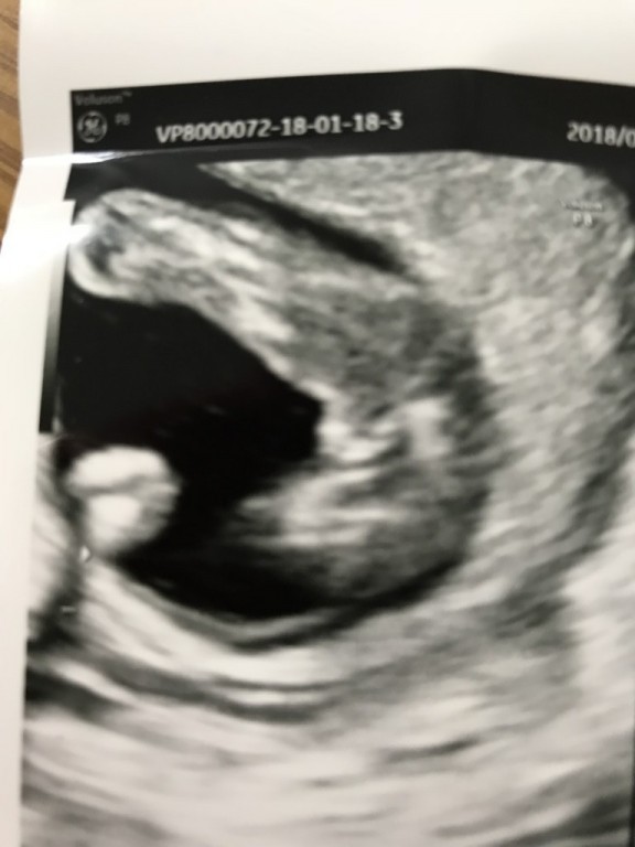 妊娠4ヶ月 妊娠12週 13週 14週 15週 妊娠初期 の超音波写真 妊娠 出産 育児に関する総合情報サイト ベビカム