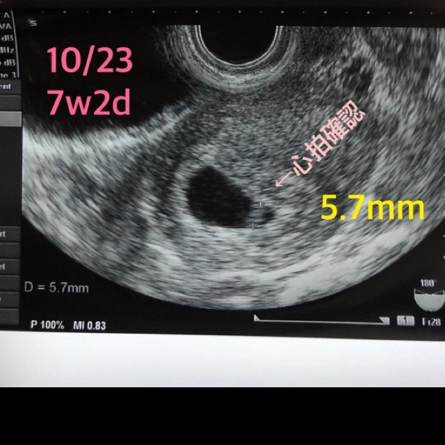  ID:10132 妊娠2ヶ月（7週2日）の写真