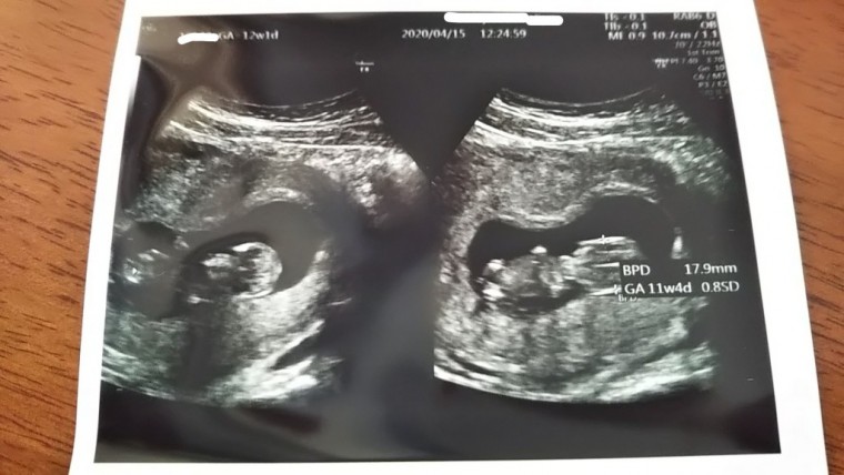 ４ヶ月目妊婦検診 ID:10612 妊娠4ヶ月（12週1日）の写真
