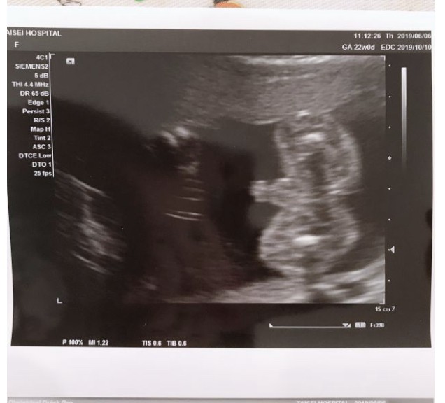 妊娠6ヶ月 妊娠週 21週 22週 23週 妊娠中期 の超音波写真 妊娠 出産 育児に関する総合情報サイト ベビカム