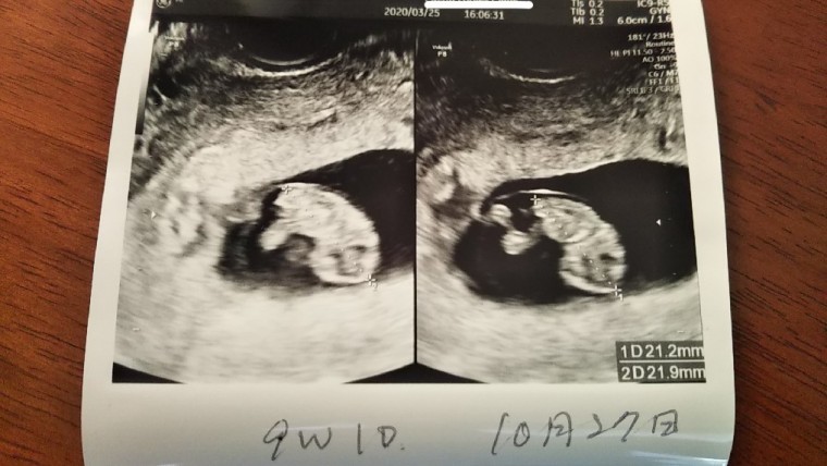 9w1d ID:10608 妊娠3ヶ月（9週1日）の写真