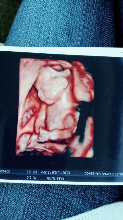 妊娠6ヶ月 妊娠20週 21週 22週 23週 妊娠中期 の超音波写真 妊娠 出産 育児に関する総合情報サイト ベビカム