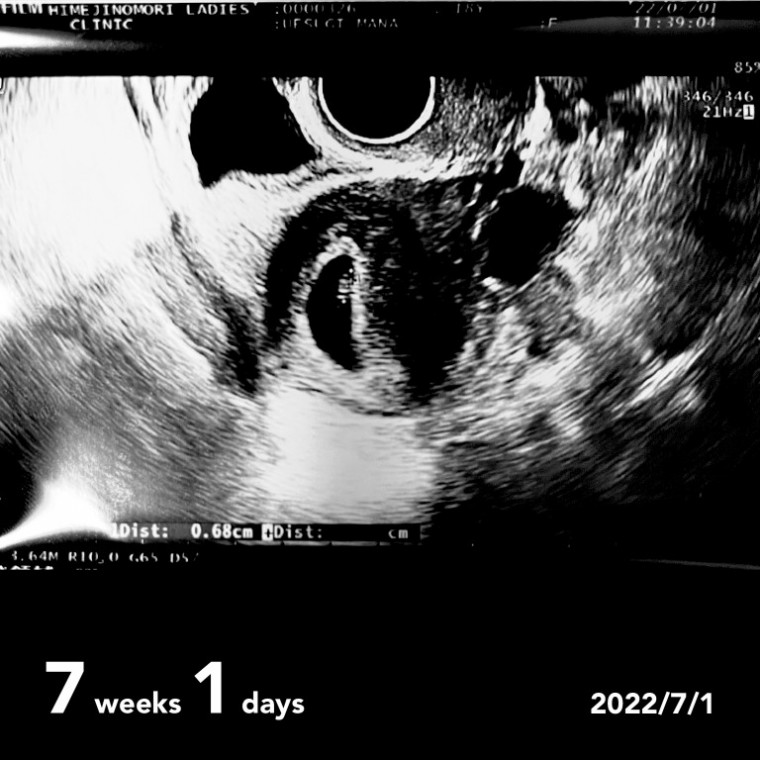 胎芽6mm　心拍確認 ID:10811 妊娠2ヶ月（7週1日）の写真