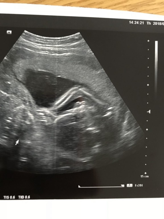 お腹のエコー 妊娠5ヶ月 19週4日 の写真 ベビカム成長記録 妊娠 出産 育児に関する総合情報サイト ベビカム