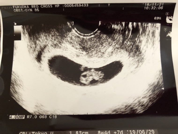 赤ちゃんがいるってびっくり ID:9296 妊娠3ヶ月（8週5日）の写真