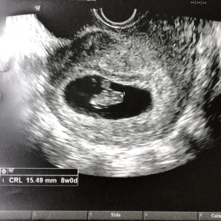 18 1 27 妊娠2ヶ月 7週6日 の写真 ベビカム成長記録 妊娠 出産 育児に関する総合情報サイト ベビカム