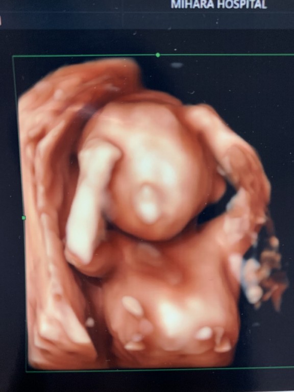 恥ずかしっ 4d Ver 妊娠5ヶ月 17週4日 の写真 ベビカム成長記録 妊娠 出産 育児に関する総合情報サイト ベビカム