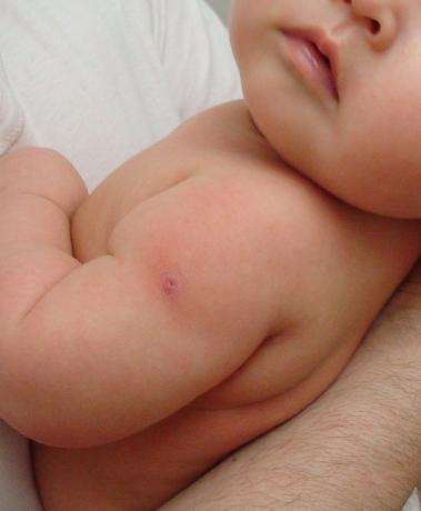 ｂｃｇ痕 日記 Yacocoさんのブログ 妊娠 出産 育児に関する総合情報サイト ベビカム