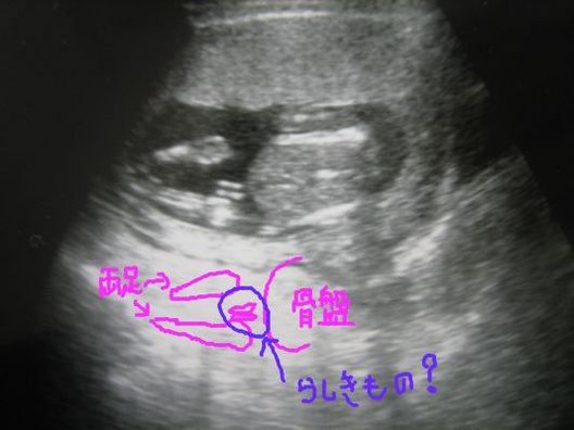 性別判明 でもやっぱりわからん 妊娠15週0日 日記 こみさんさんのブログ 妊娠 出産 育児に関する総合情報サイト ベビカム