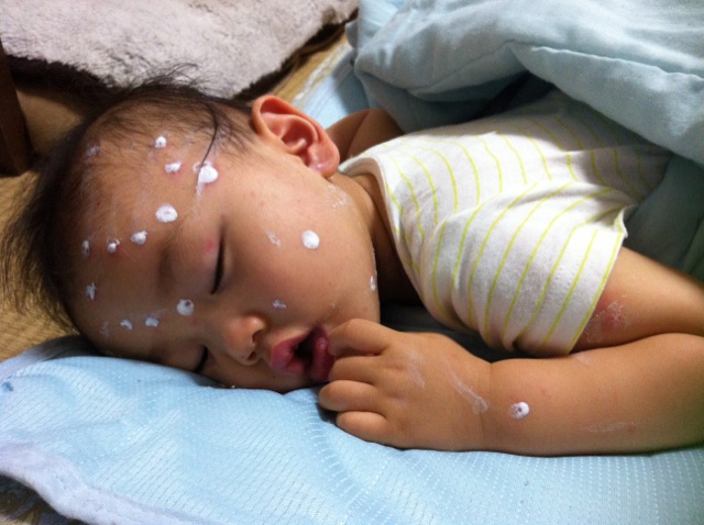水疱瘡なう D 日記 Acotakeさんのブログ 妊娠 出産 育児に関する総合情報サイト ベビカム 水疱瘡なう D 日記 Acotakeさんのブログ 妊娠 出産 育児に関する総合情報サイト ベビカム