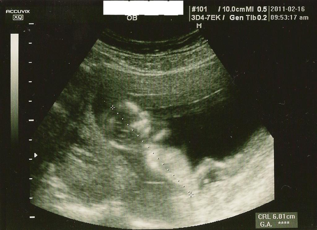 下腹部痛で受診 １２ｗ６ｄ 日記 あーや さんのブログ 妊娠 出産 育児に関する総合情報サイト ベビカム