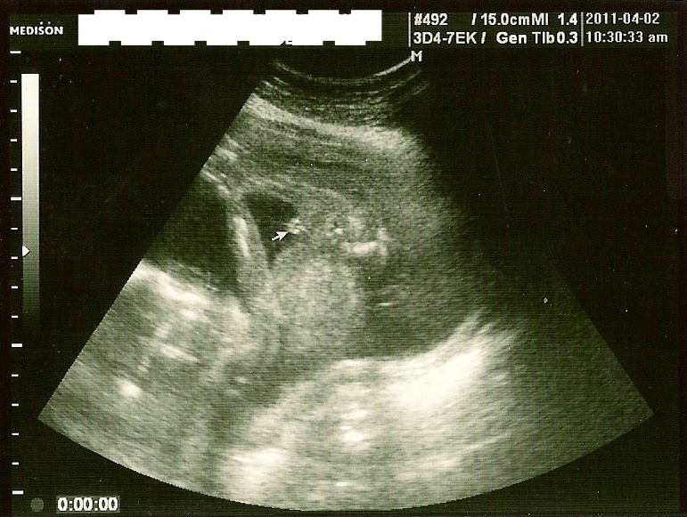 定期健診4回目 19w2d 性別判明 日記 あーや さんのブログ 妊娠 出産 育児に関する総合情報サイト ベビカム 定期健診4回目 19w2d 性別判明 日記 あーや さんのブログ 妊娠 出産 育児に関する総合情報サイト ベビカム