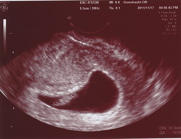 不安の２週間 胎芽 心拍確認 ５ｗ４ｄ ７ｗ１ｄ 日記 凛 Ring さんのブログ 妊娠 出産 育児に関する総合情報サイト ベビカム